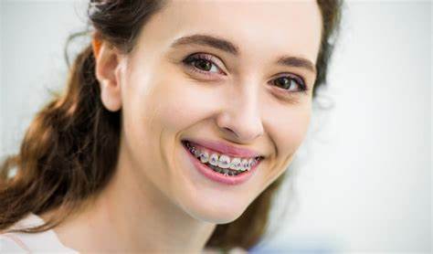 Braces 101