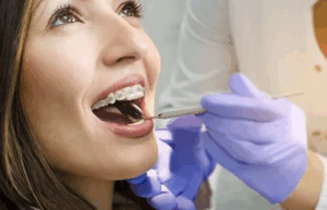 Braces 101