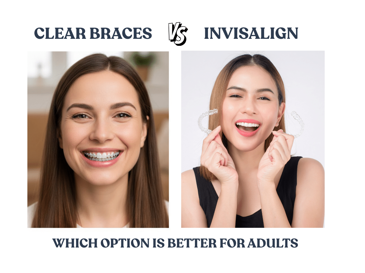 Clear Braces vs Invisalign for Adults