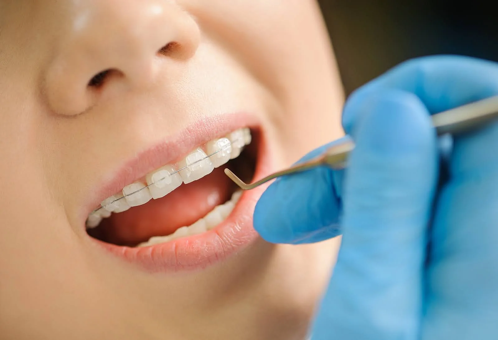 Clear Braces for adults